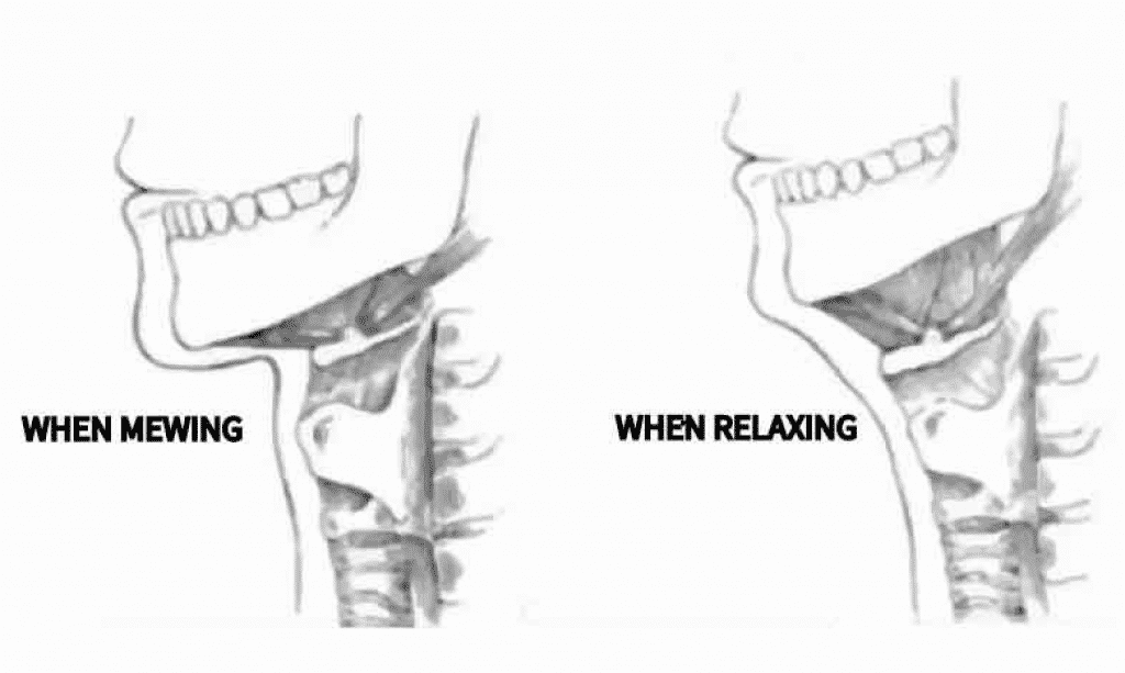 Mewing Before and After Diagram