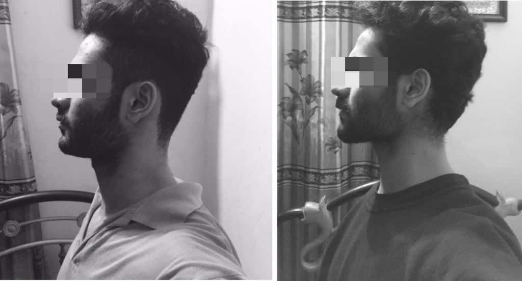 mewing before and after 1 year