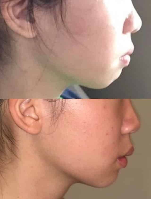 6 months of mewing before and after