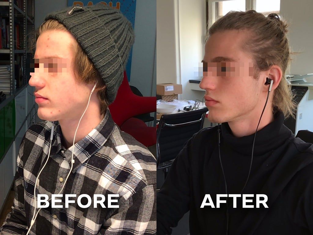 Mewing-before-and-after